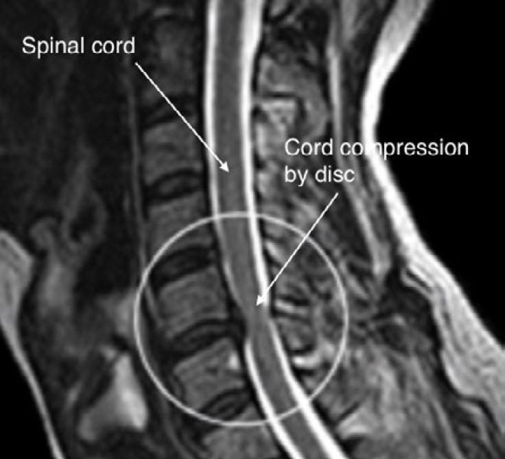 Neck Pain and Cervical Fusion - Dr Timothy Steel | Neurosurgery Journal